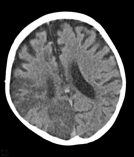 19A1 Infarcts, Hypo Hrt, LVAD (Case 19) CT 1