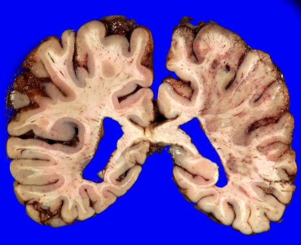 19B2 Infarcts, Hypo Hrt, LVAD (Case 19) 3