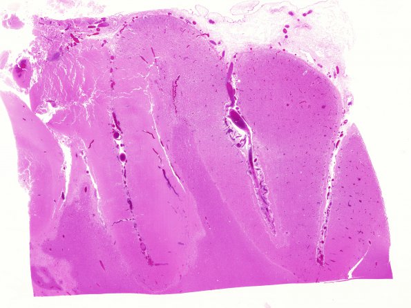 19C1 Infarcts, Hypo Hrt, LVAD (Case 19) N14 WM