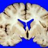 1A1 Infarct, Embolic (Case 1) 37cAA