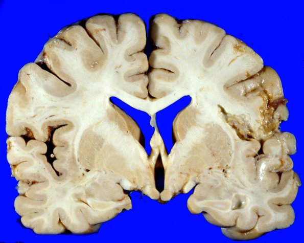 1A1 Infarct, Embolic (Case 1) 37cAA