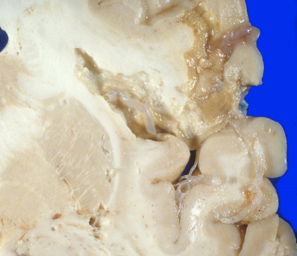 1A2 Infarct, resolving (Case 1) gross