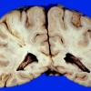 1A3 Embolic Infarct (Case 1)