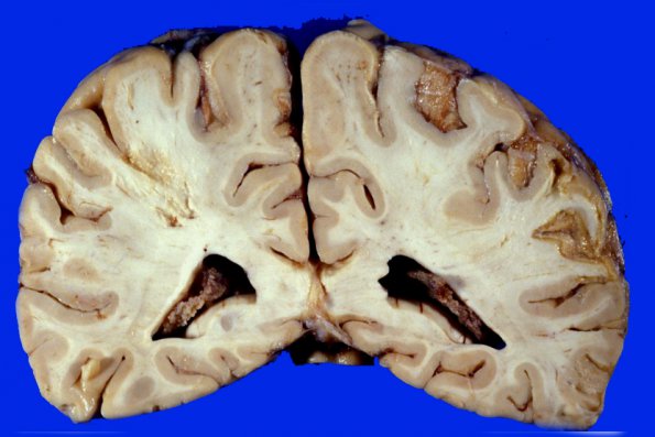 1A3 Embolic Infarct (Case 1)