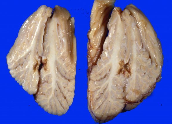 1A5 Infarct, Embolic (Case 1) 37a