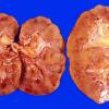 1B1 Infarct, Embolic (Case 1)