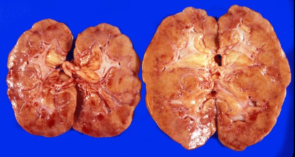 1B1 Infarct, Embolic (Case 1)