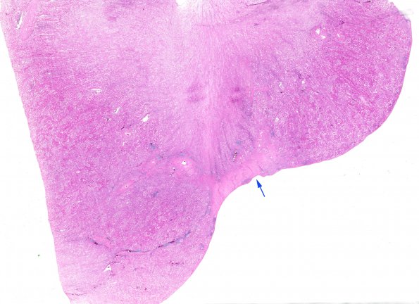 1B2 (Case 1) H&E Kidney WM copy