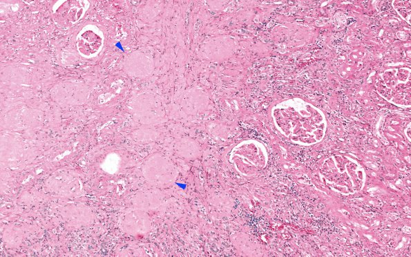 1B3 (Case 1) H&E Kidney 10X copy