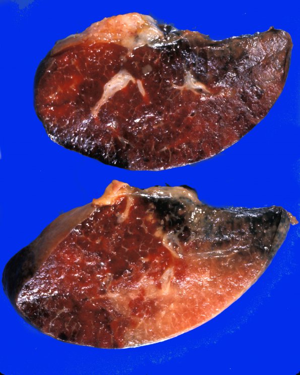 1B4 Infarct, Embolic, (Case 1) lung