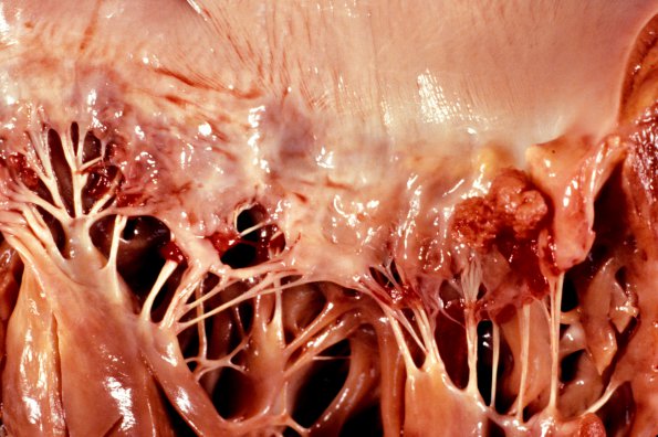 1C Infarct, Embolic, (Case 1) b