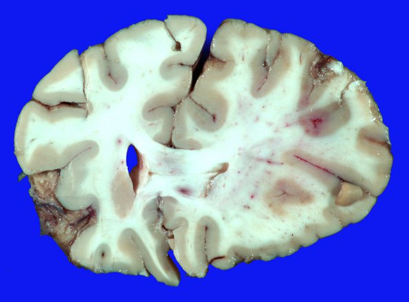 20A1 Catheter Sheath Emboli (Case 20)