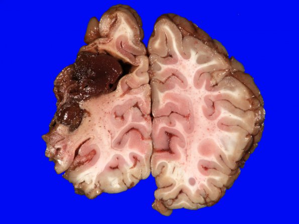 21A1 Infarct & Hemorrhage, 9 mo old, T Fallot (Case 21) Gross_8