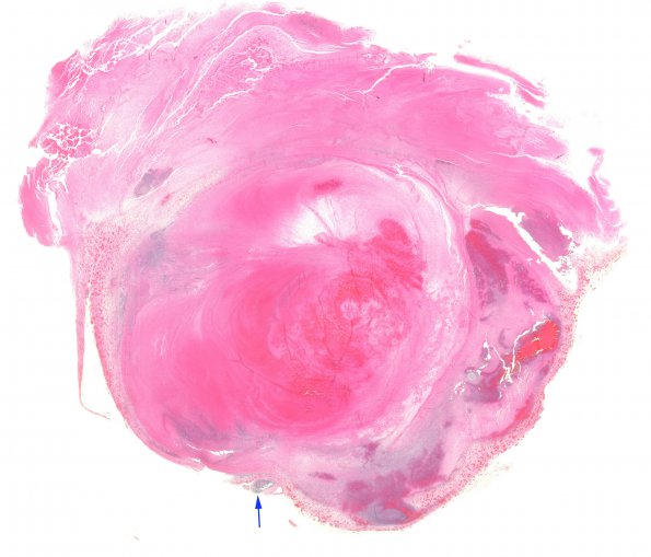 21B1 Hemorrhage, embolic, hydrophilic polymer (Case 21 N14) H&E WM