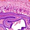 21B4 Hemorrhage, embolic, hydrophilic polymer (Case 21) H&E 7