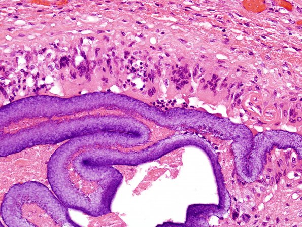 21B4 Hemorrhage, embolic, hydrophilic polymer (Case 21) H&E 7