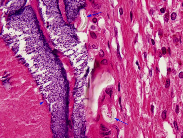 21B5A Hemorrhage, embolic, hydrophilic polymer (Case 21) N14 H&E 100x copy