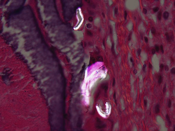 21B5B Hemorrhage, embolic, hydrophilic polymer (Case 21) N14) H&E 100x polarized.