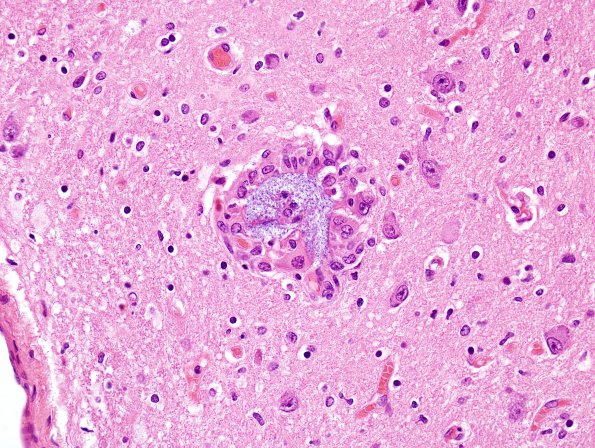 21B6 Hemorrhage, embolic, hydrophilic polymer (Case 21) N14) H&E 6