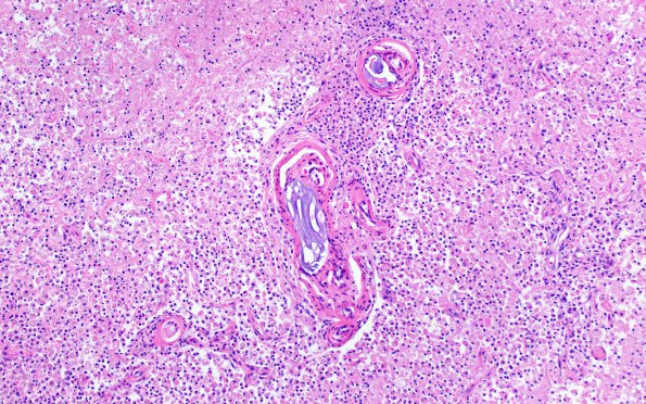 22B2 Emboli, intravascular hydrophilic polymer (Case 22) H&E 4 10X