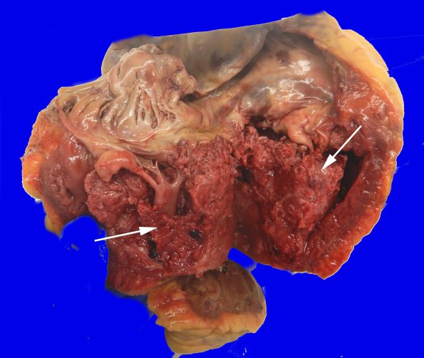 23A1Heart R Ventricle (Case 23) copy