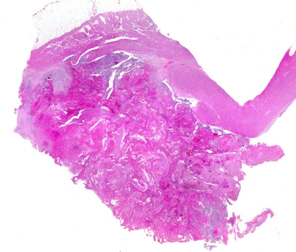 23B1 Heart (Case 23) H&E 1GRV1 WM