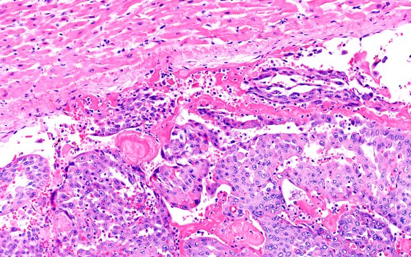23B2 Heart (Case 23) H&E 1GRV1 20X