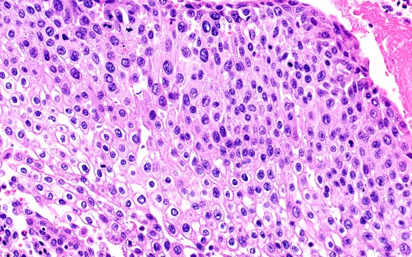 23B3 Heart (Case 23) H&E 1GRV3 40X