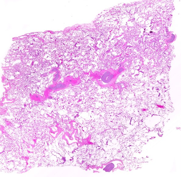 23C1 Lung emboli (Case 23) H&E 1FU1 WM