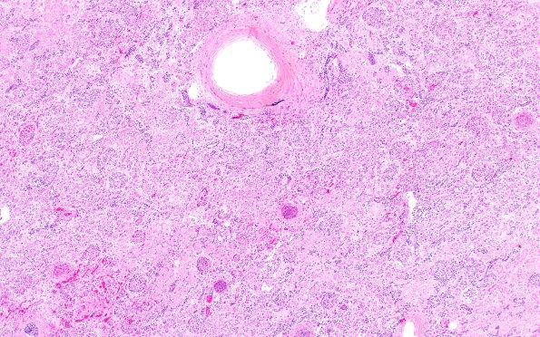 23D1 Kidney (Case 23) H&E 1L2 4X A