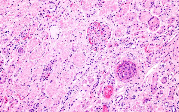 23D2 Kidney (Case 23) H&E 1L2 20X
