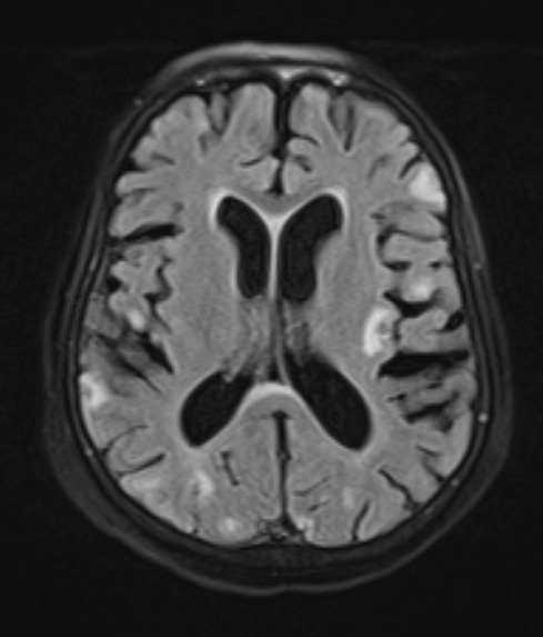 23E Infarct tumor embolus (Case 23) T2 FLAIR - Copy