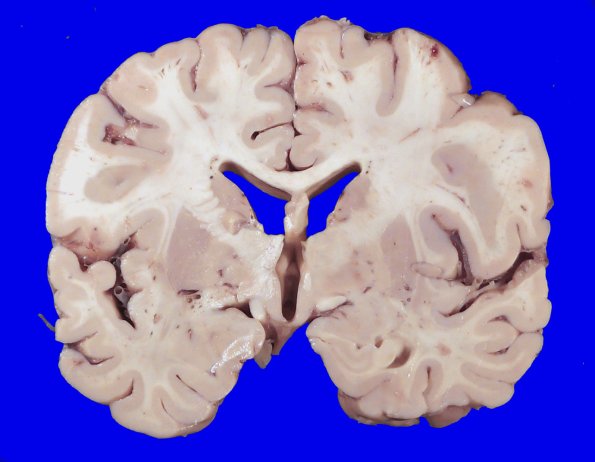 23F1 Infarct tumor embolus (Case 23) 1_2
