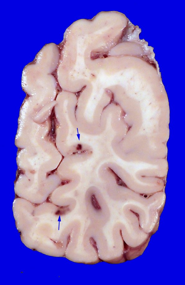 23F3 Infarct tumor embolus (Case 23) 1_5 copy
