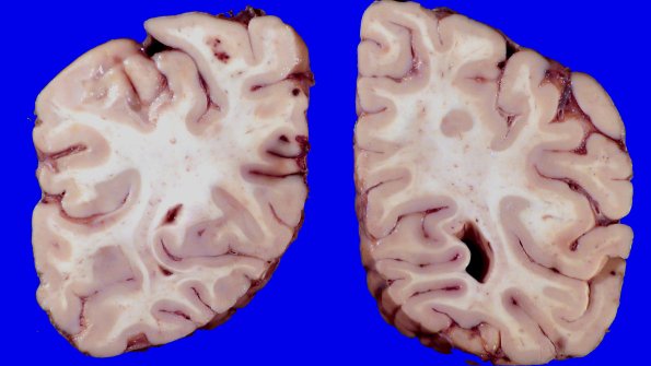 23F4 Infarct tumor embolus (Case 23) 1_4