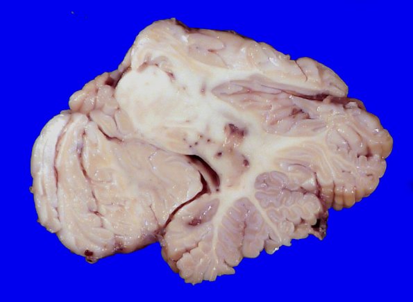 23F5 Infarct tumor embolus (Case 23) 1_6