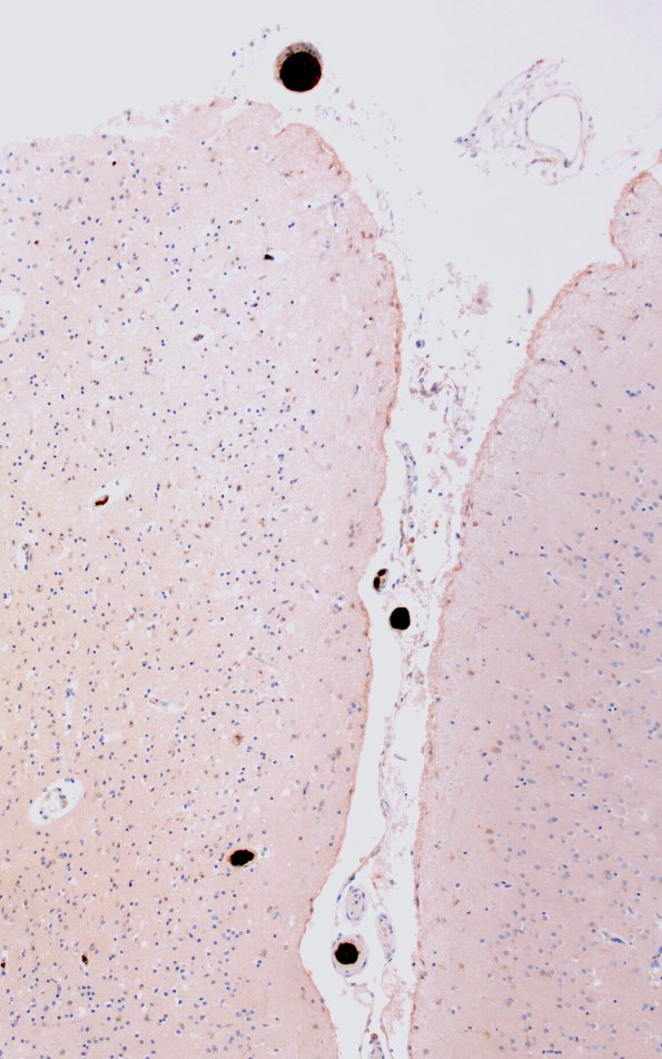 23G5 Infarct tumor embolus (Case 23) N5 CK5.6 10X