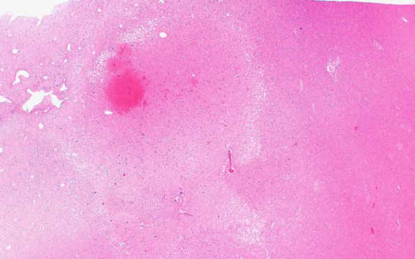 23J1 Infarct tumor embolus (Case 23) N19 2X