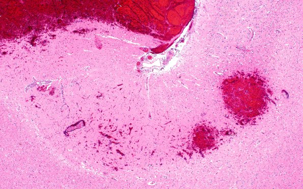 23K1 Infarct tumor embolus (Case 23) N13 4X