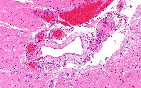 23K2 Infarct tumor embolus (Case 23) N13 4X