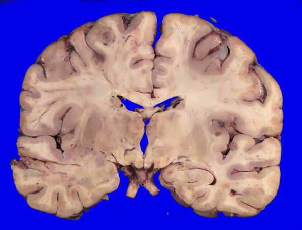 24B4A (Case 24) A.017