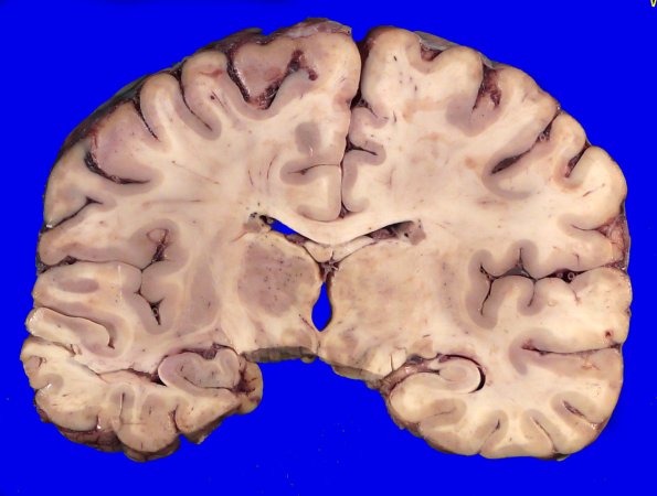 24B5 (Case 24) A.022