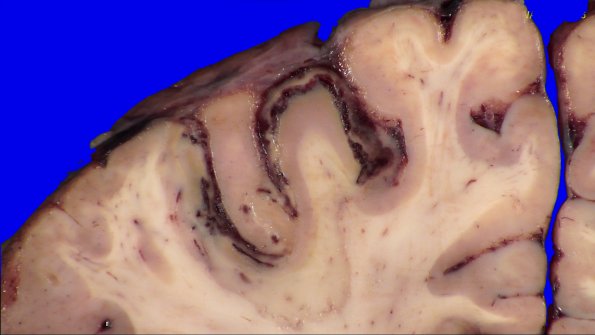 24B8B (Case 24) A.028