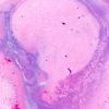 24C2 Emboli, septic (Case 24) A11 H&E 2X