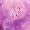 24D1 Emboli, septic (Case 24) A11 Gram 2X