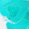 24E1 Emboli, septic (Case 24) A11 GMS WMA