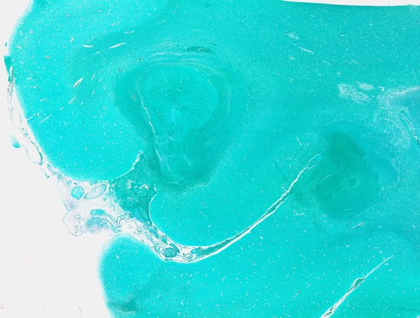 24E1 Emboli, septic (Case 24) A11 GMS WMA