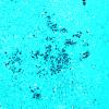 24E3A Emboli, septic (Case 24) A11 GMS 20X
