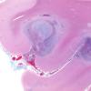 24F1 Emboli, septic (Case 24) A11 Tri WM