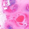24H2 Emboli, septic (Case 24) A14 H&E 2X